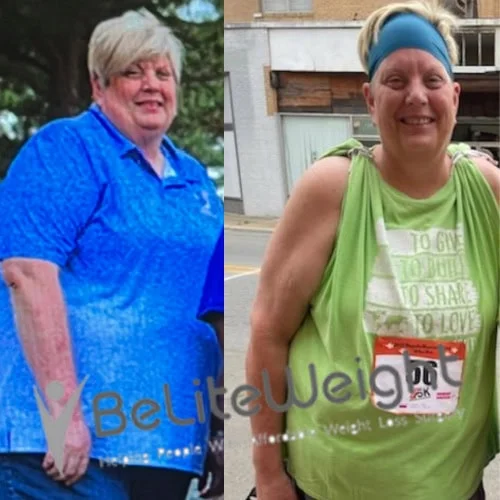 Weight Loss Surgery Before And After